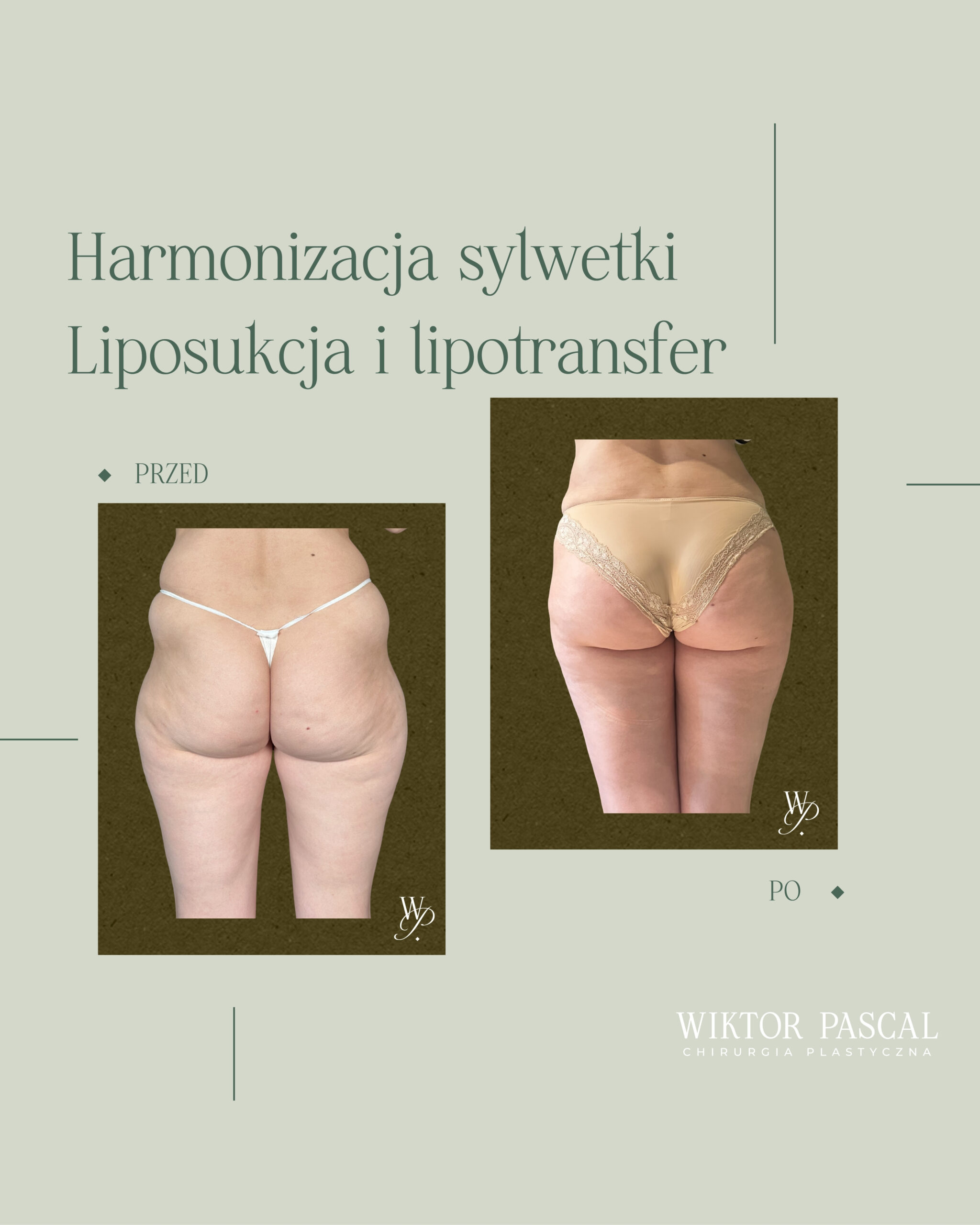 Liposukcja jako modelowanie sylwetki – dla kogo daje najlepsze efekty?