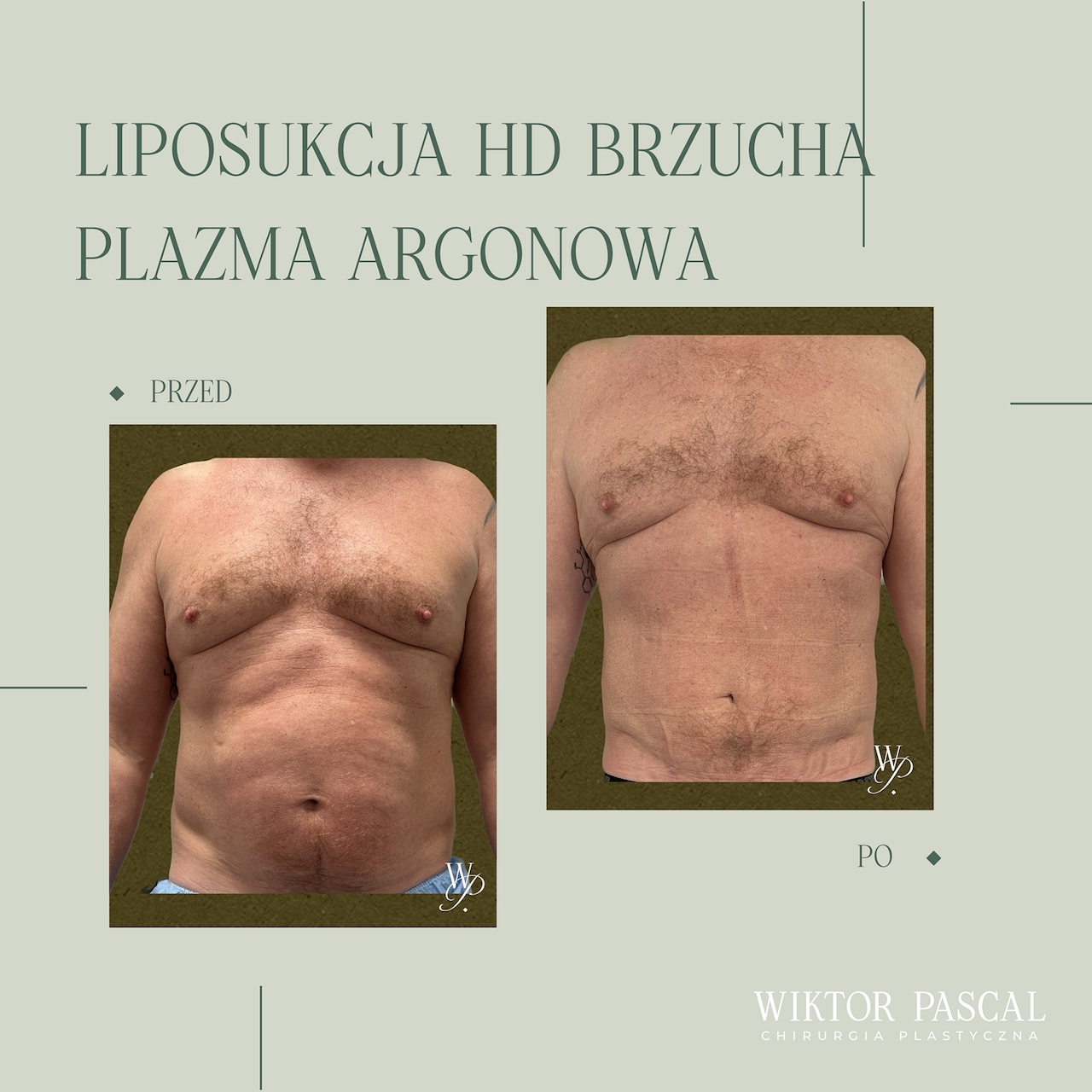 Liposukcja brzucha – efekty, przebieg i dla kogo zabieg ma największy sens