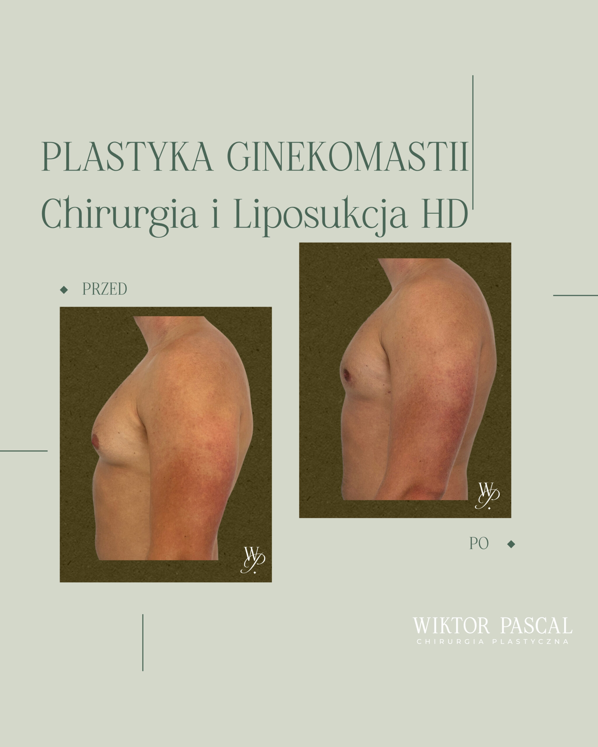 Ginekomastia – co to jest, skąd się bierze i kiedy warto rozważyć zabieg?