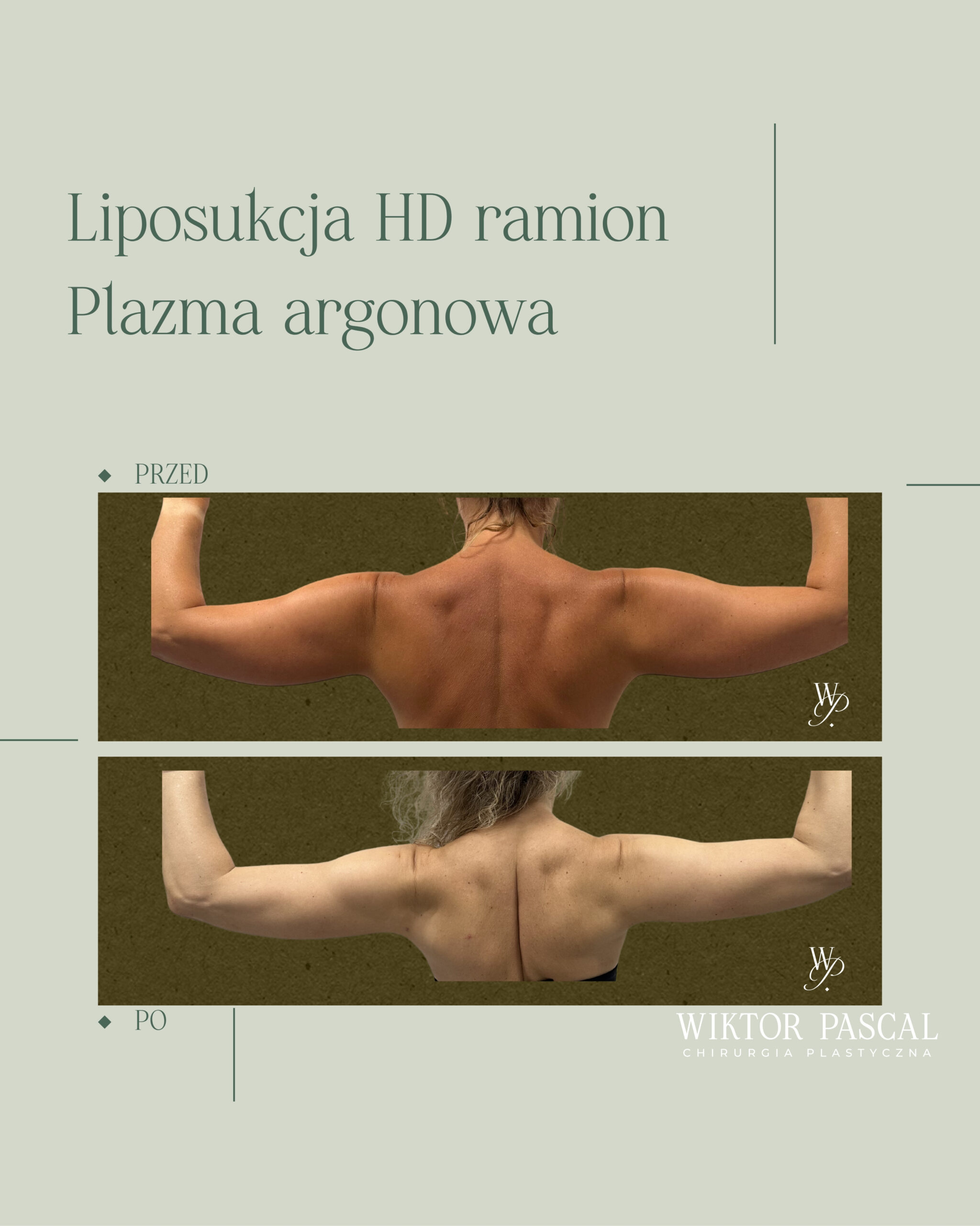 Liposukcja a jakość skóry – dlaczego elastyczność tkanek ma kluczowe znaczenie?
