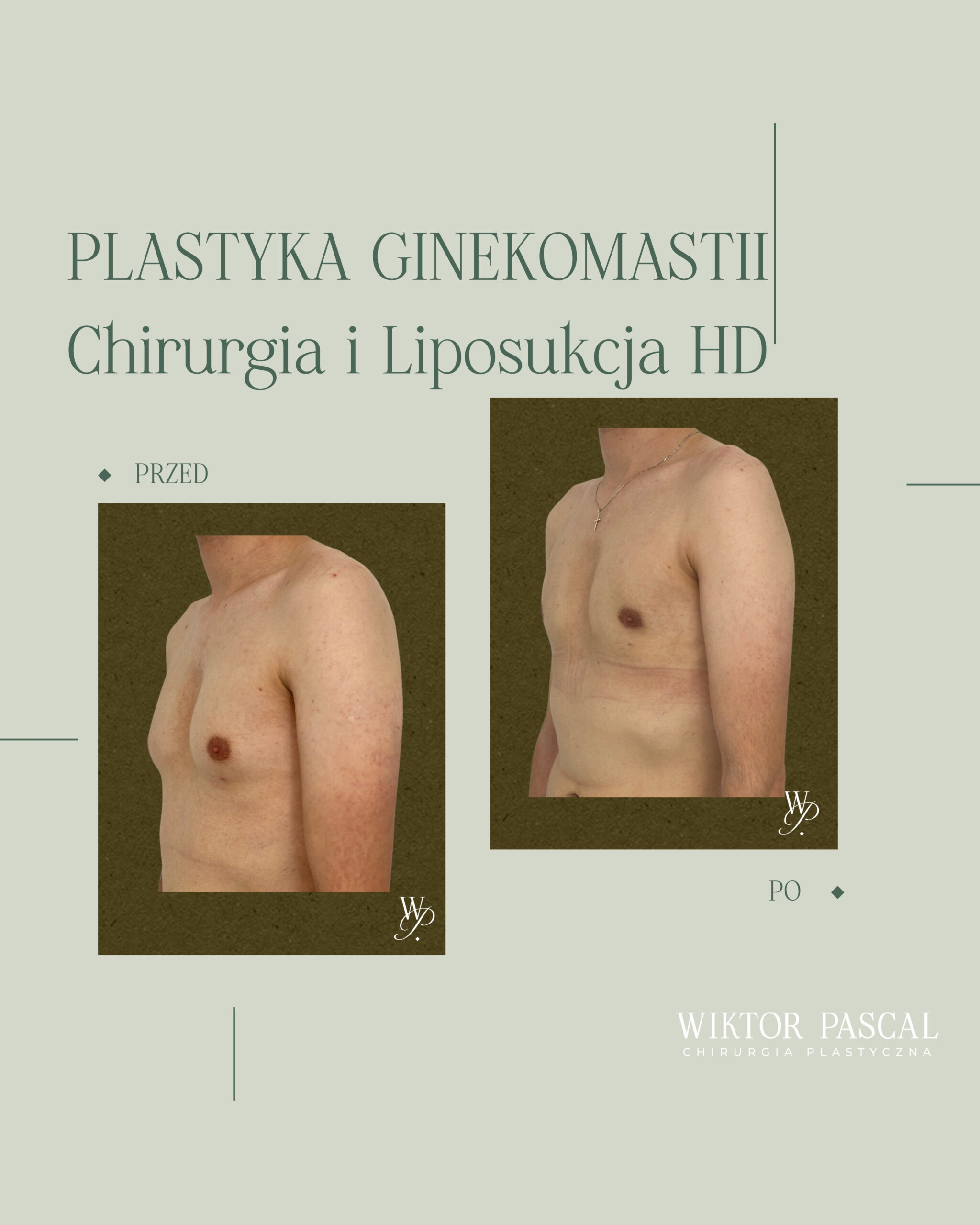 Czy ginekomastia może wrócić po operacji? Nawrót, przyczyny i profilaktyka
