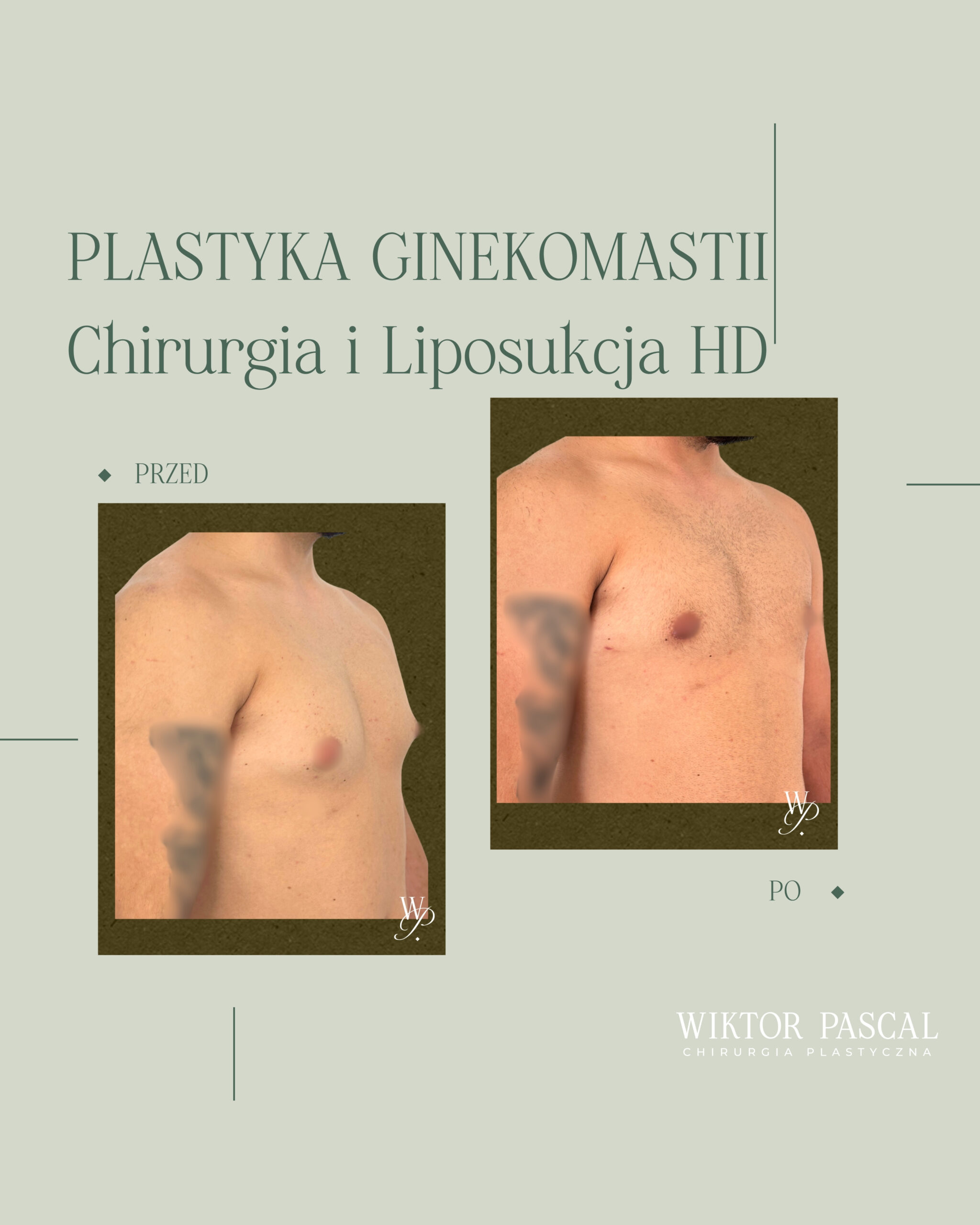 Operacja ginekomastii premium – jak uzyskać naturalny, męski kontur klatki piersiowej?