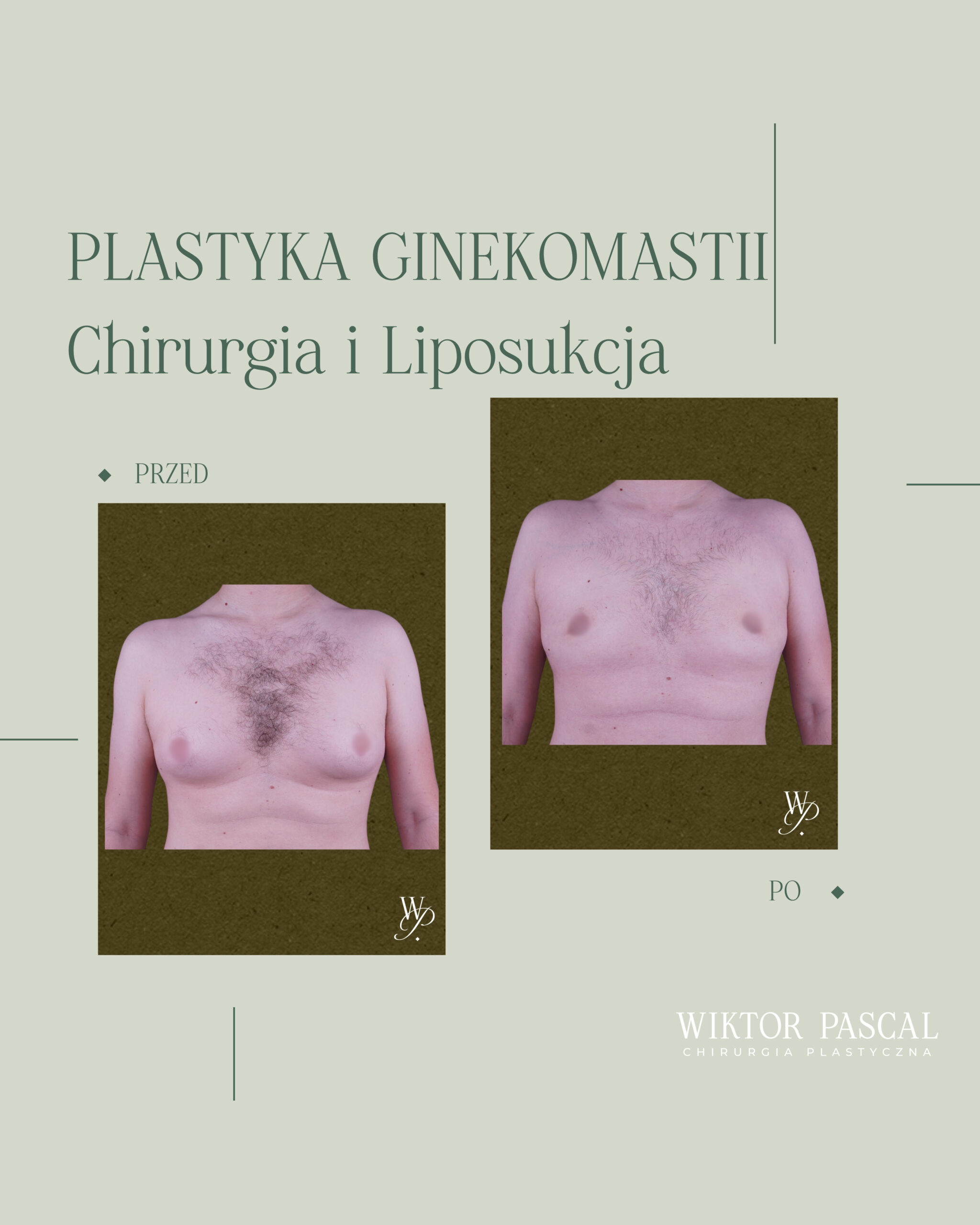 Ginekomastia i wiotka skóra – kiedy potrzebna jest redukcja nadmiaru skóry?