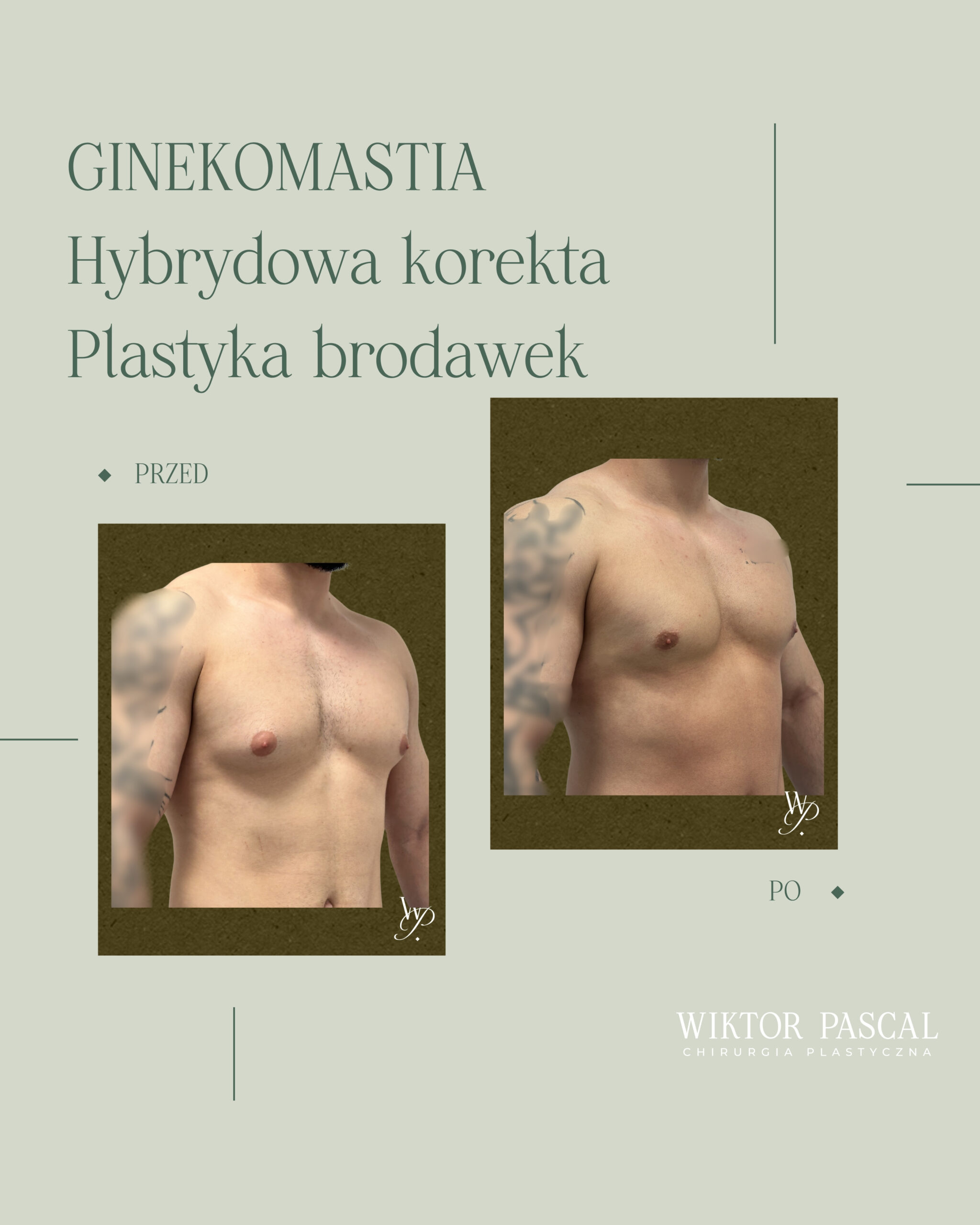 Brodawka i otoczka w ginekomastii – poszerzenie, repozycjonowanie i naturalny efekt