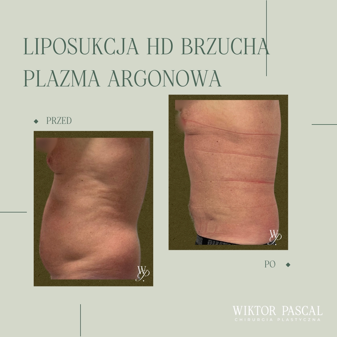 Liposukcja HD – co to jest, jakie daje efekty i czym różni się od klasycznej liposukcji?