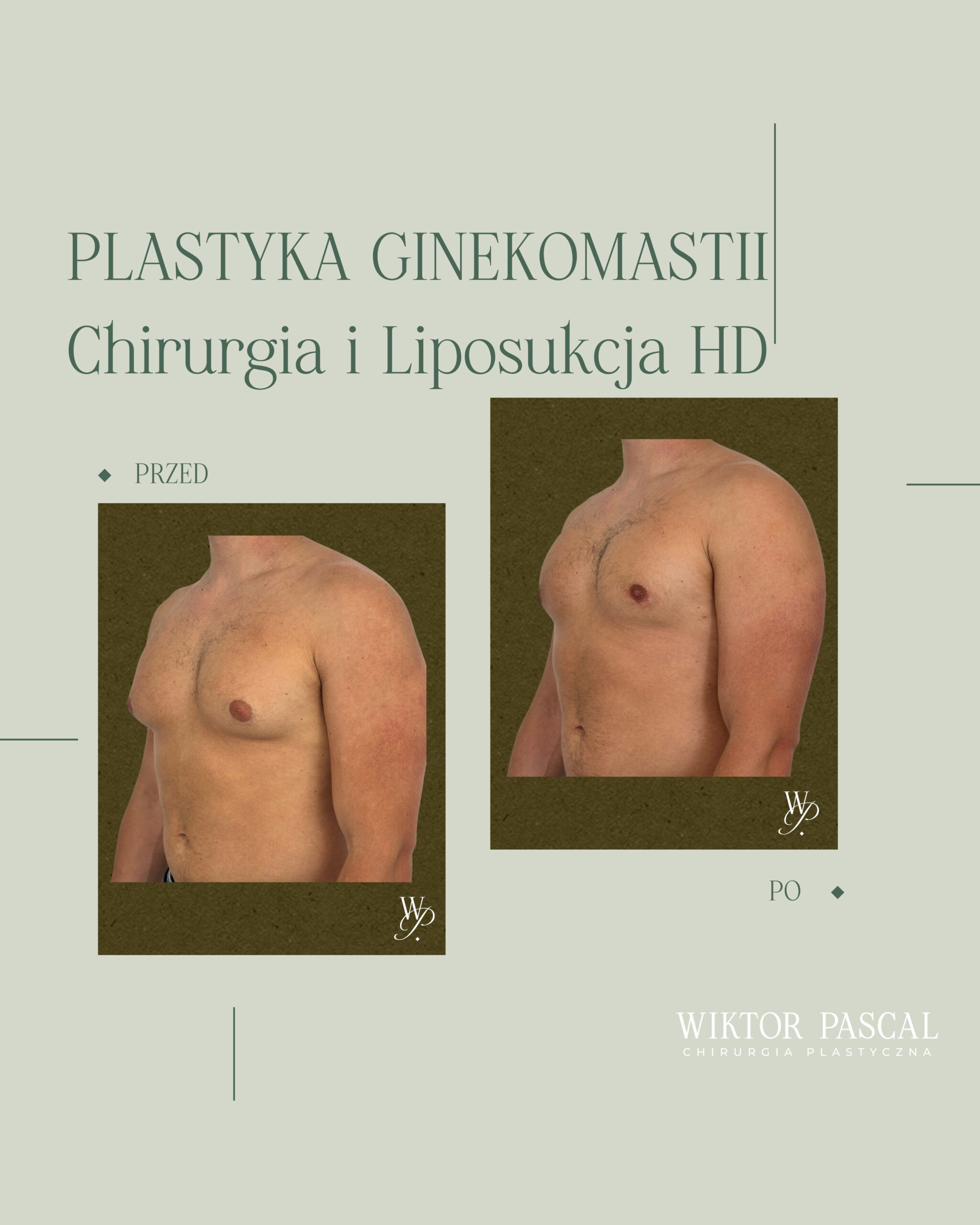 Ginekomastia a psychika – wstyd, siłownia, relacje i jakość życia