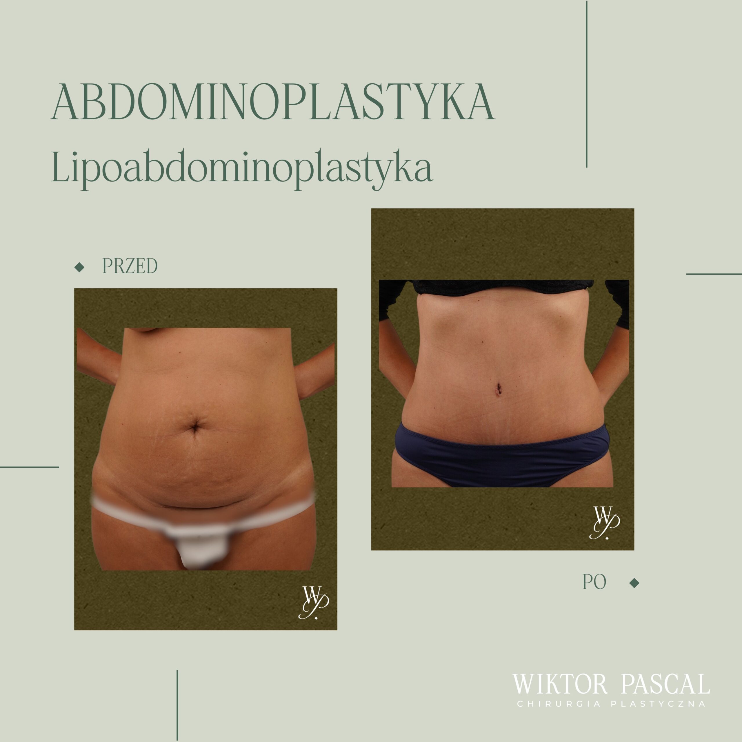 Kiedy liposukcja nie wystarczy? Granice zabiegu i alternatywy chirurgiczne