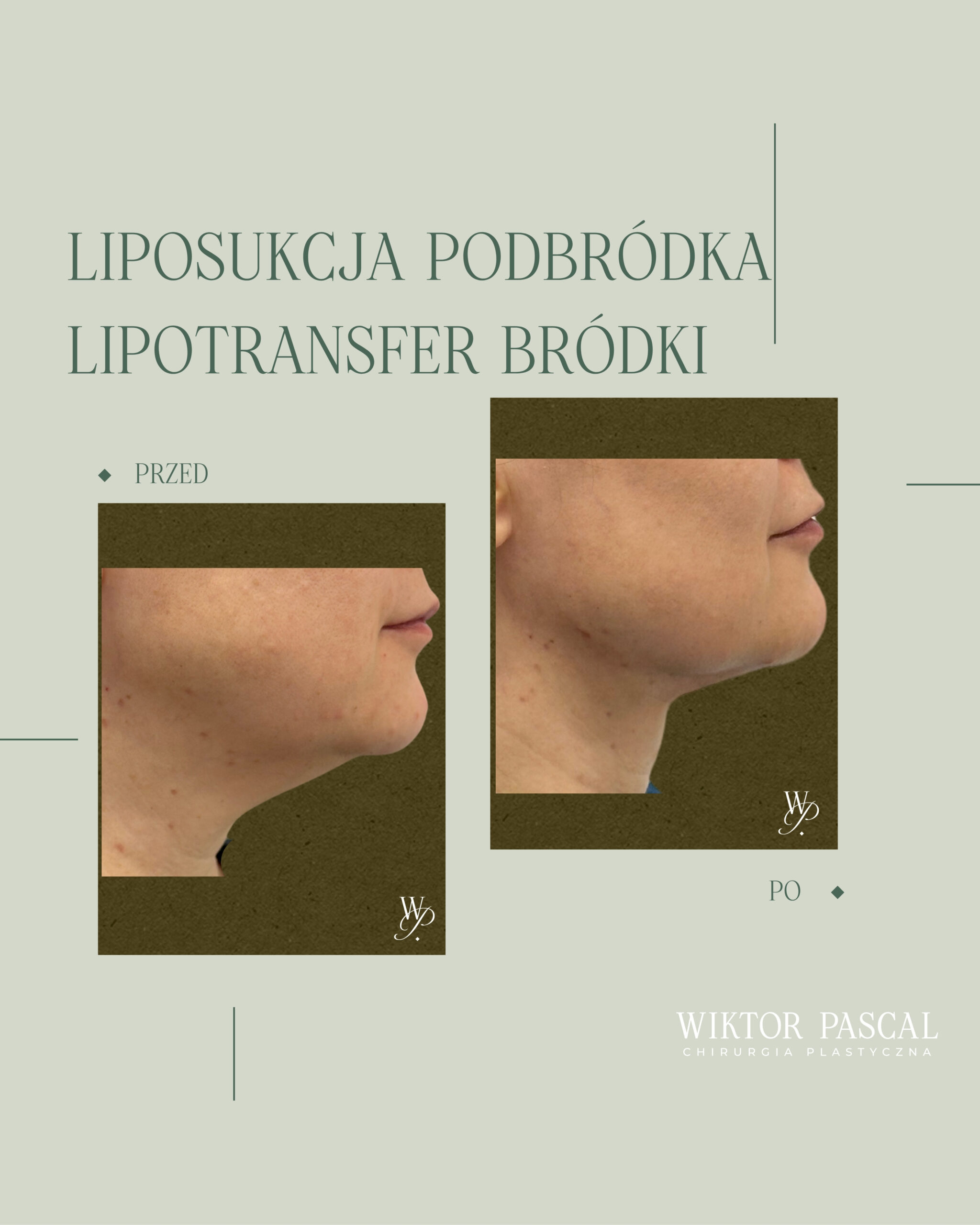 Kiedy liposukcja nie wystarczy? Granice zabiegu i alternatywy chirurgiczne