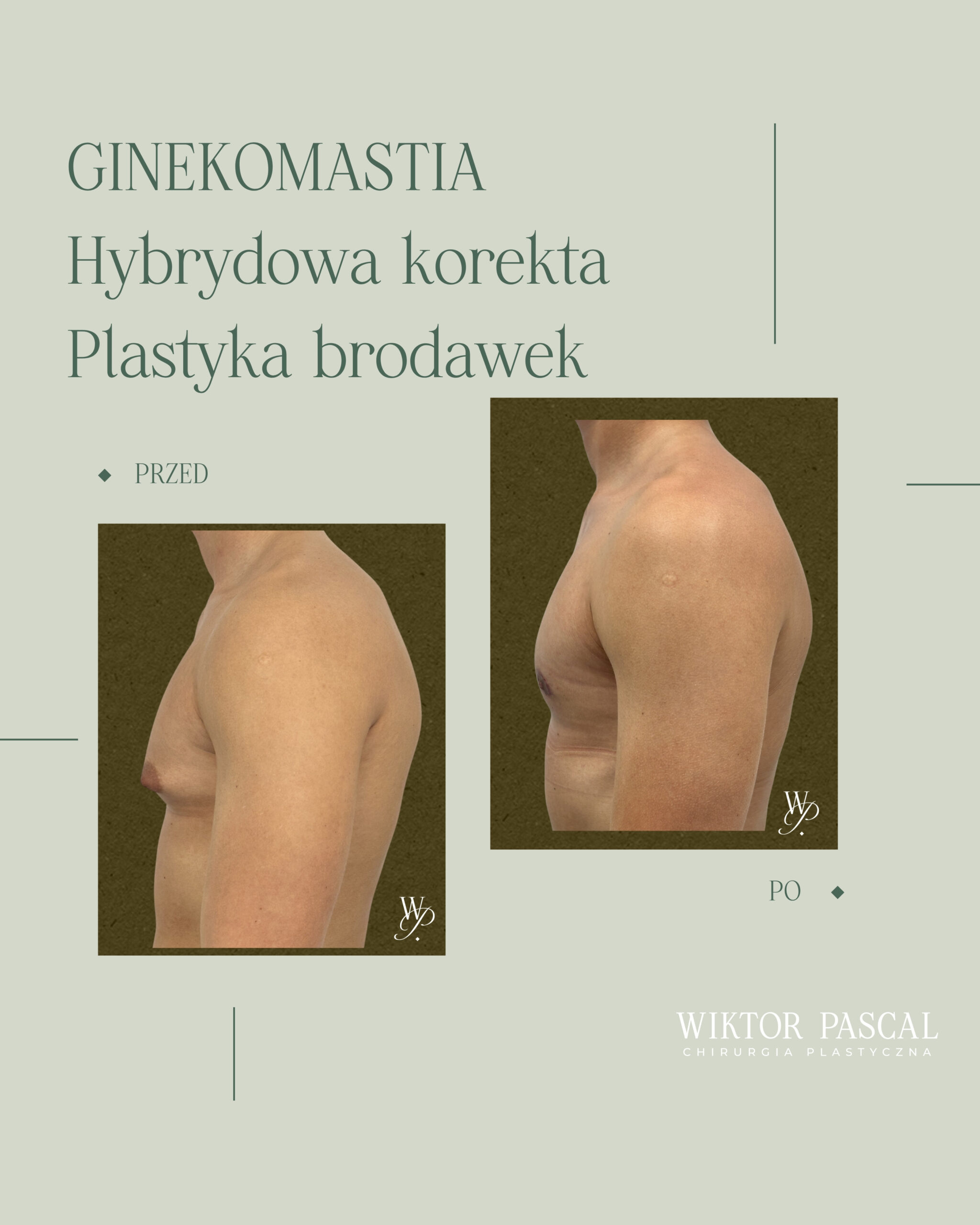 Jak przygotować się do operacji ginekomastii?