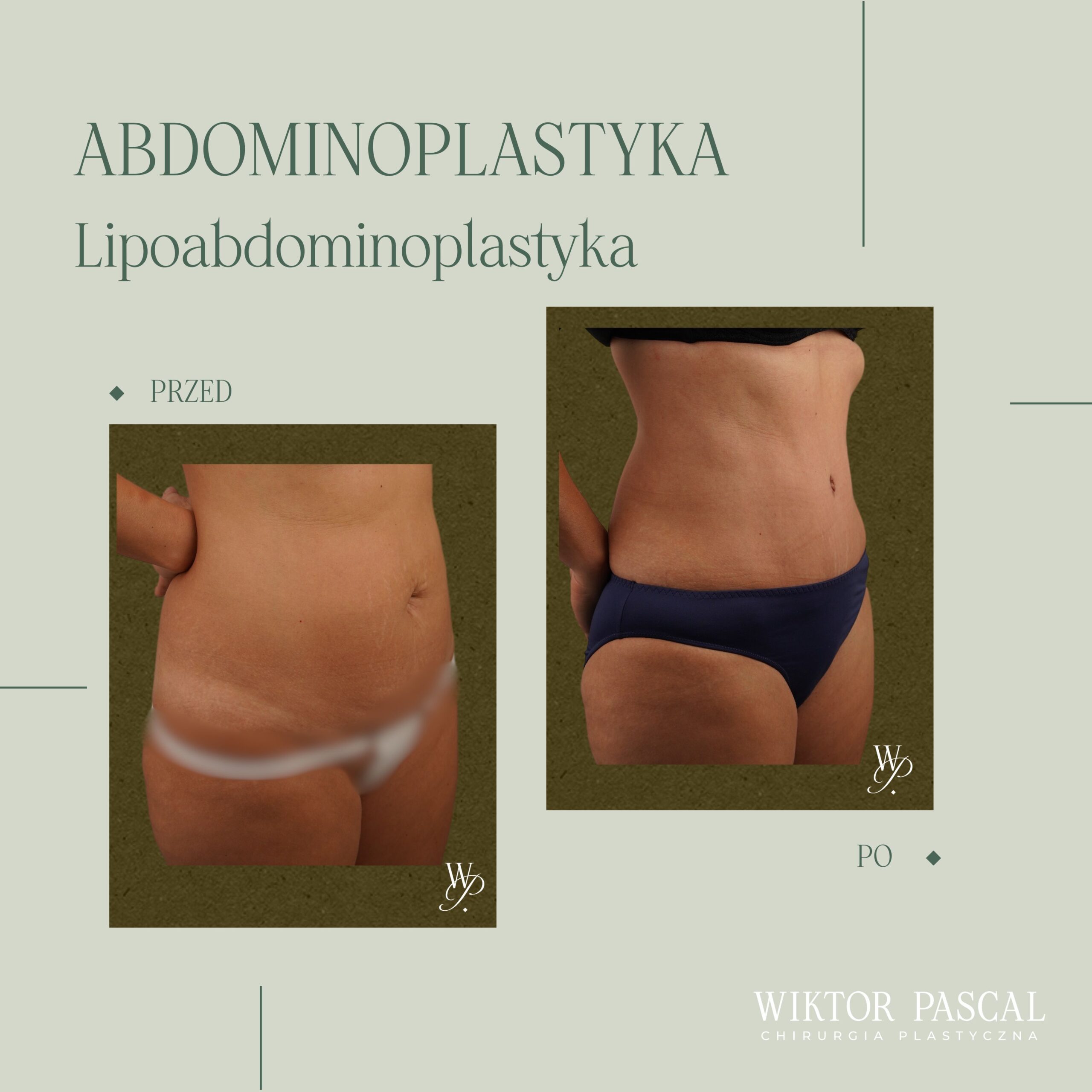 Liposukcja czy modelowanie sylwetki łączone – kiedy warto połączyć techniki?