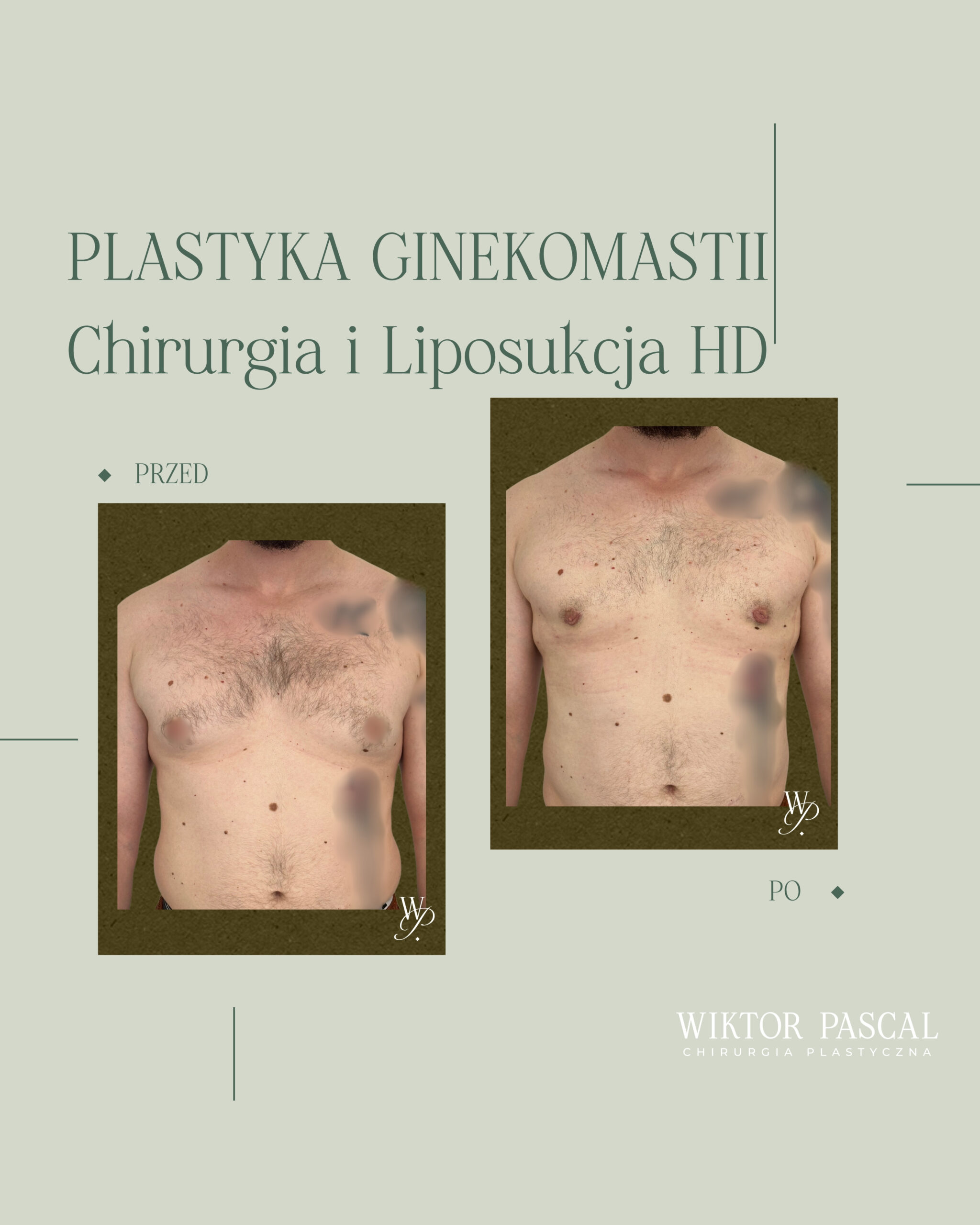 Rekonwalescencja po operacji ginekomastii – szybki powrót do pracy i treningu