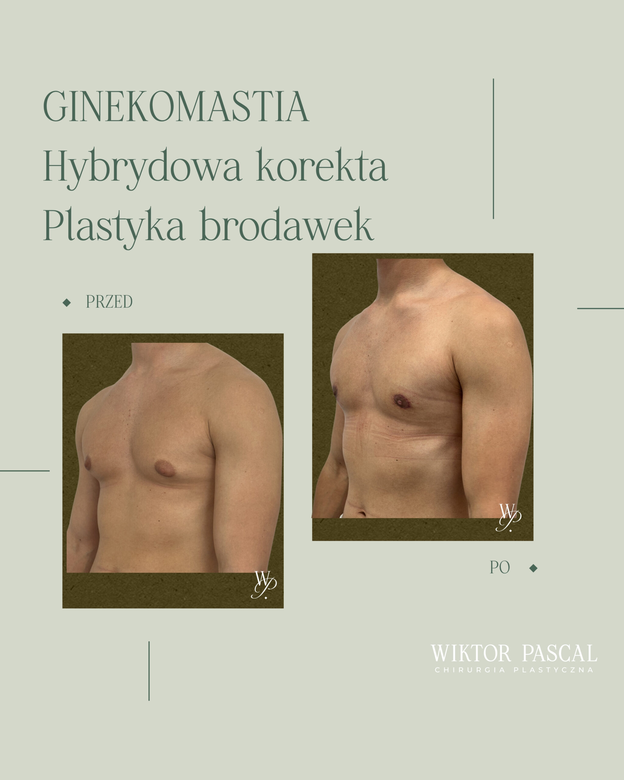 Ginekomastia u aktywnych mężczyzn – siłownia, sylwetka i przerośnięty gruczoł