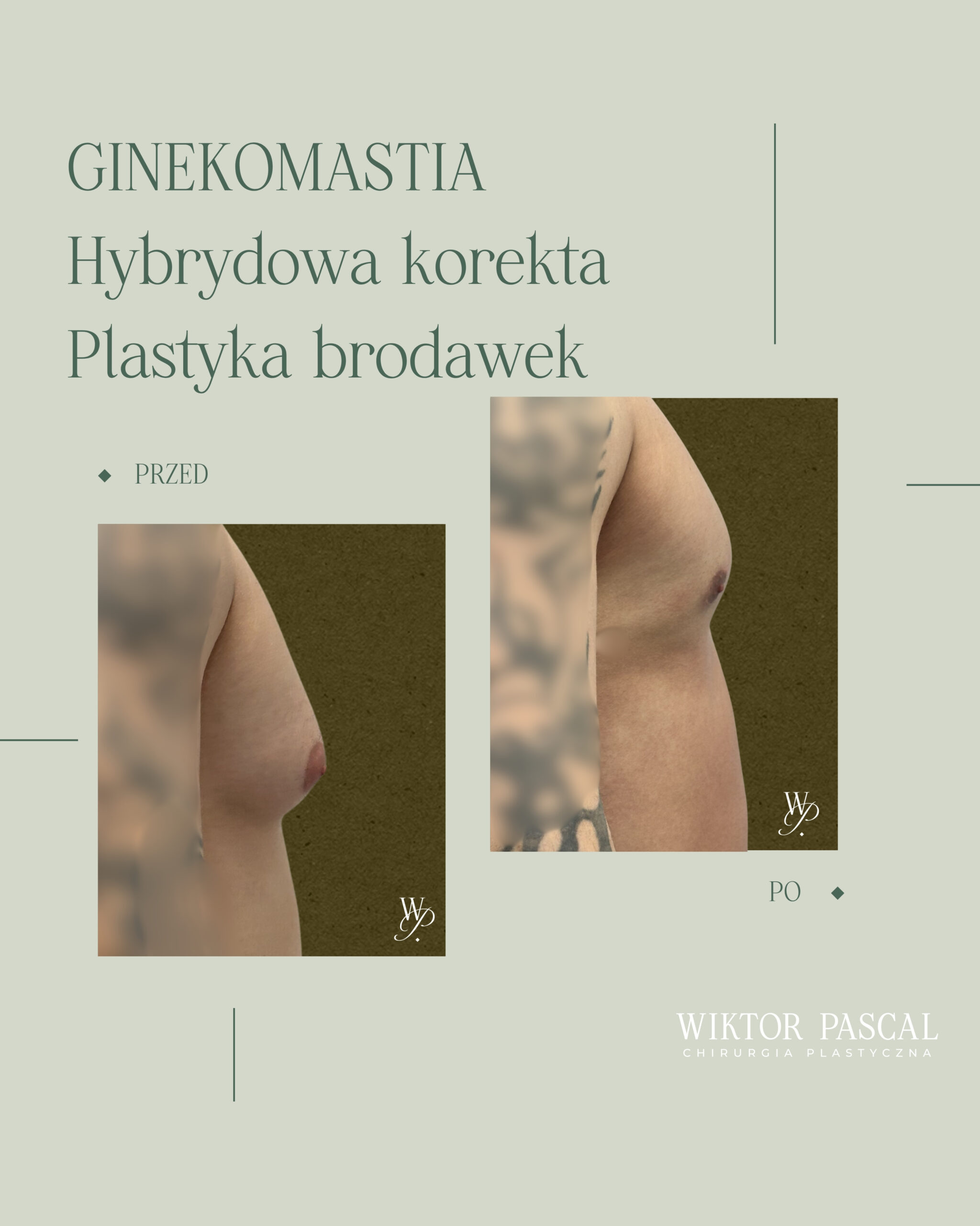 Liposukcja ultradźwiękowa, plazma argonowa i lipotransfer w leczeniu ginekomastii